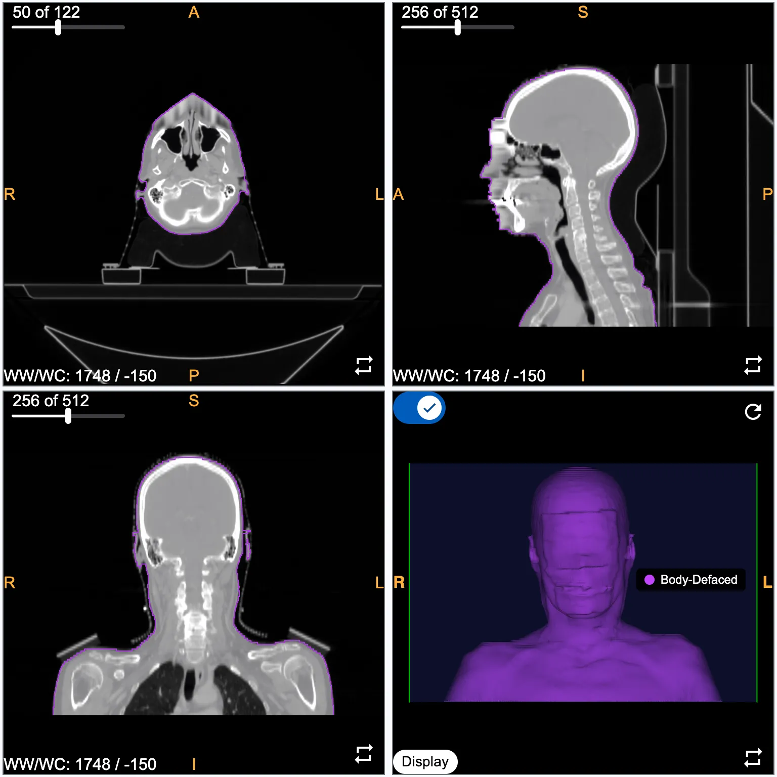 Same scan after mask-based defacing — facial geometry removed, internal anatomy intact