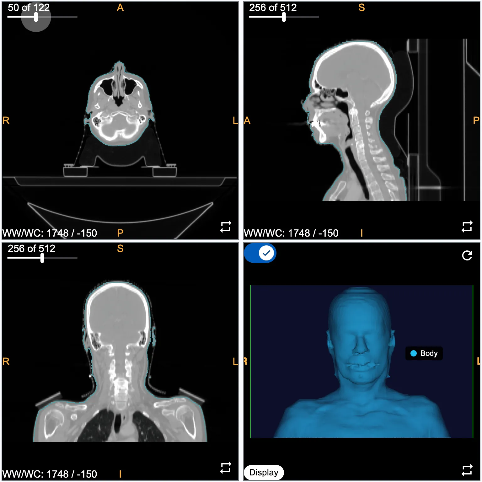Original head CT — four-panel viewer with axial, sagittal, coronal slices and 3-D volume render