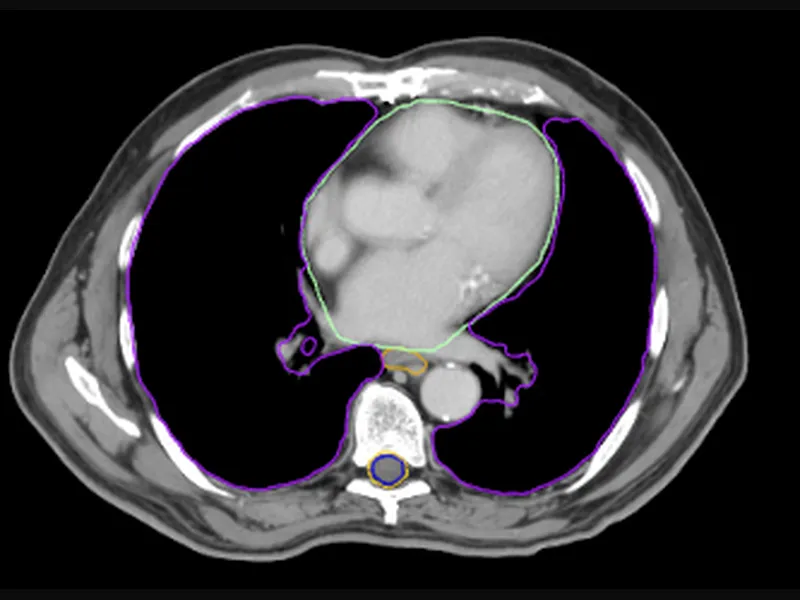 Thoracic CT contour example with lung, heart and substructures, esophagus, and spinal cord