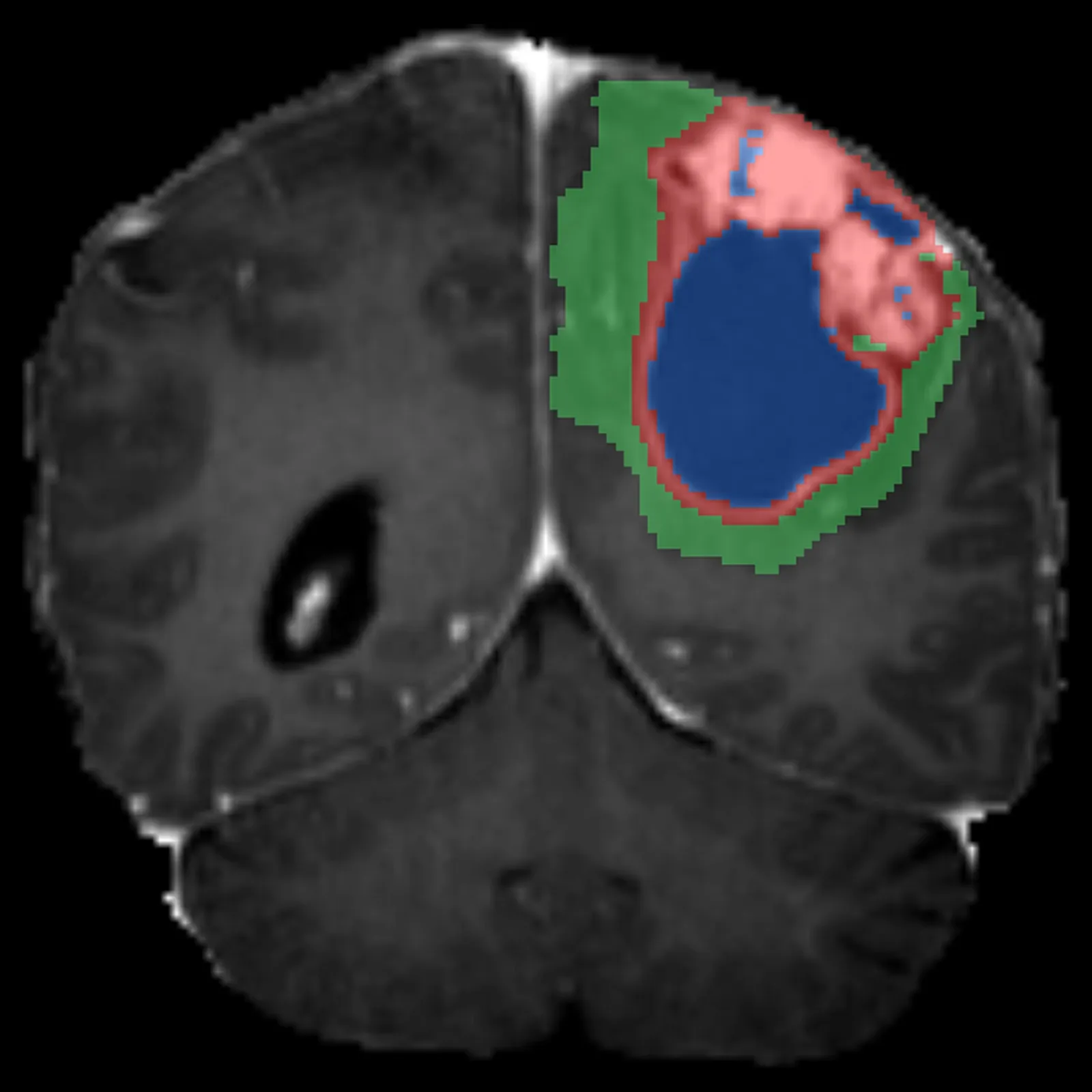 NeuroStage brain tumor segmentation — enhancing tumor, non-enhancing core, and peritumoral edema overlaid on a coronal MRI slice