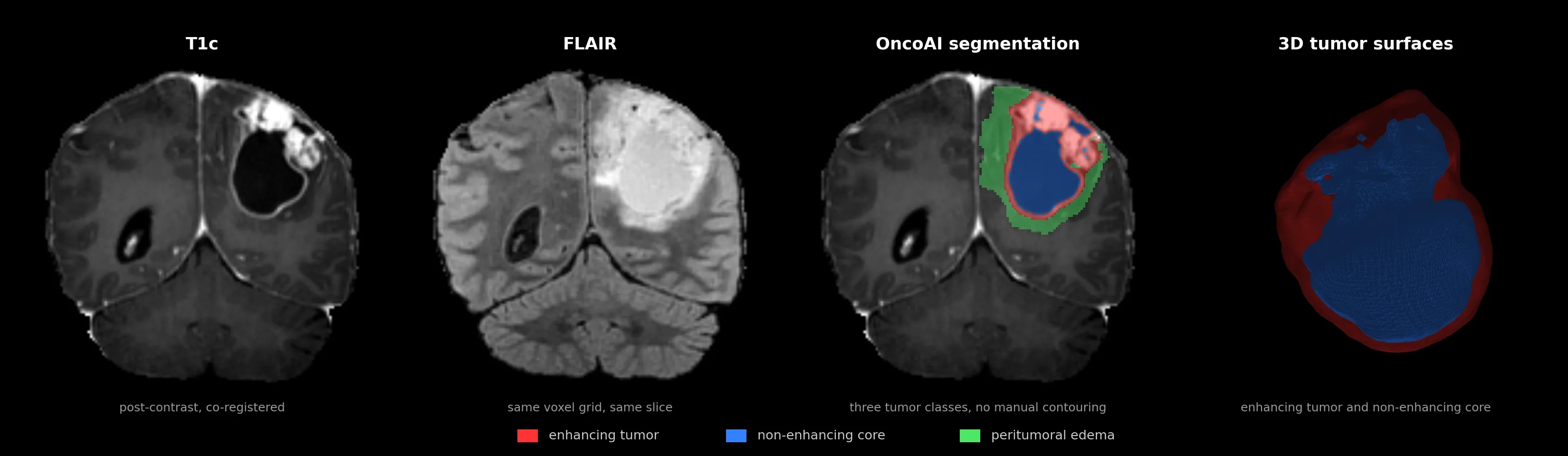Four panels from the demo study: T1c, FLAIR, OncoAI segmentation overlay (enhancing tumor, non-enhancing core, peritumoral edema), and 3D tumor surfaces