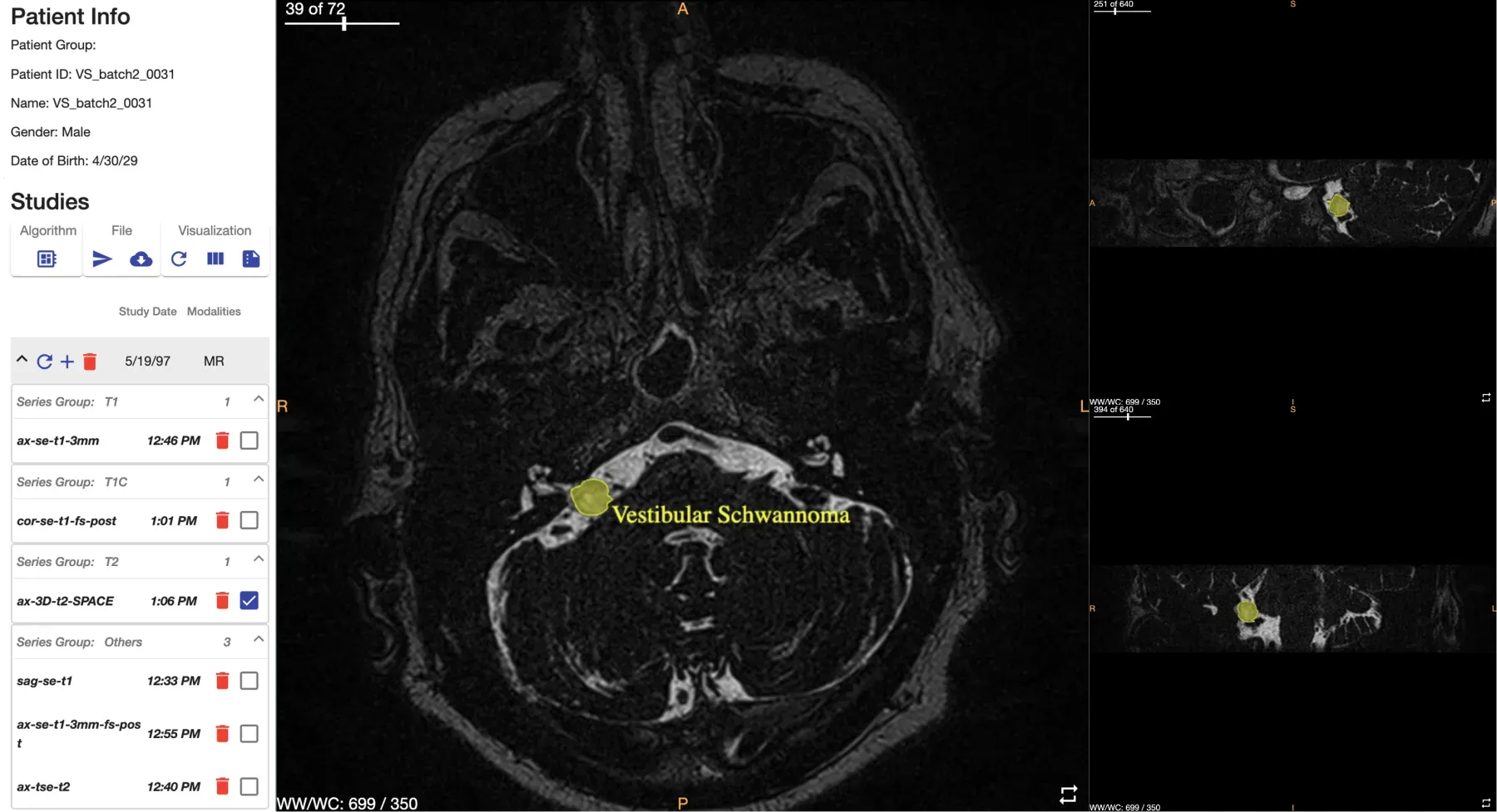 OncoAI BrainTumor workstation segmenting a vestibular schwannoma on axial MRI with sagittal and coronal reformats