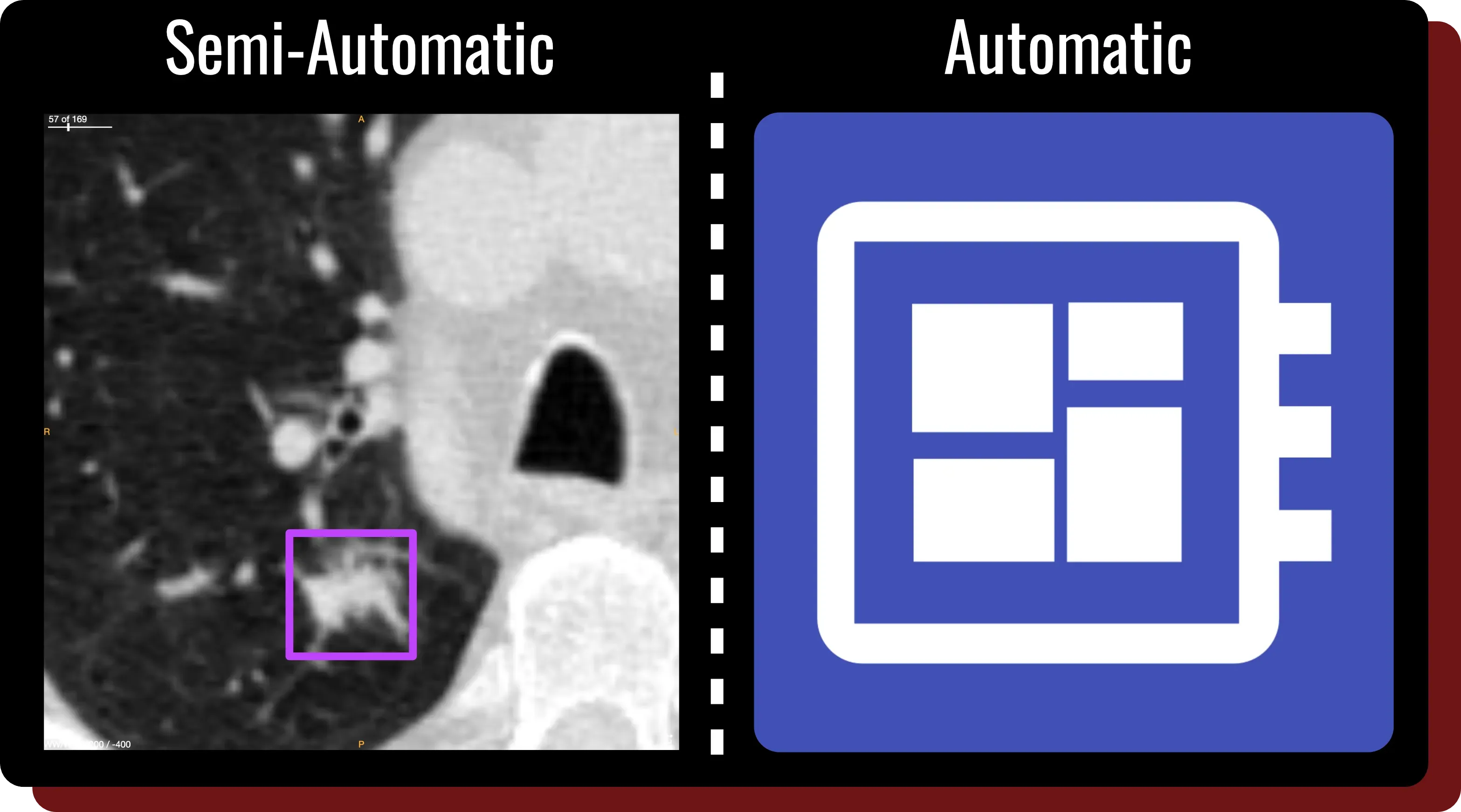 OncoAI LungNodule comparison of semi-automatic and automatic detection on a chest CT slice