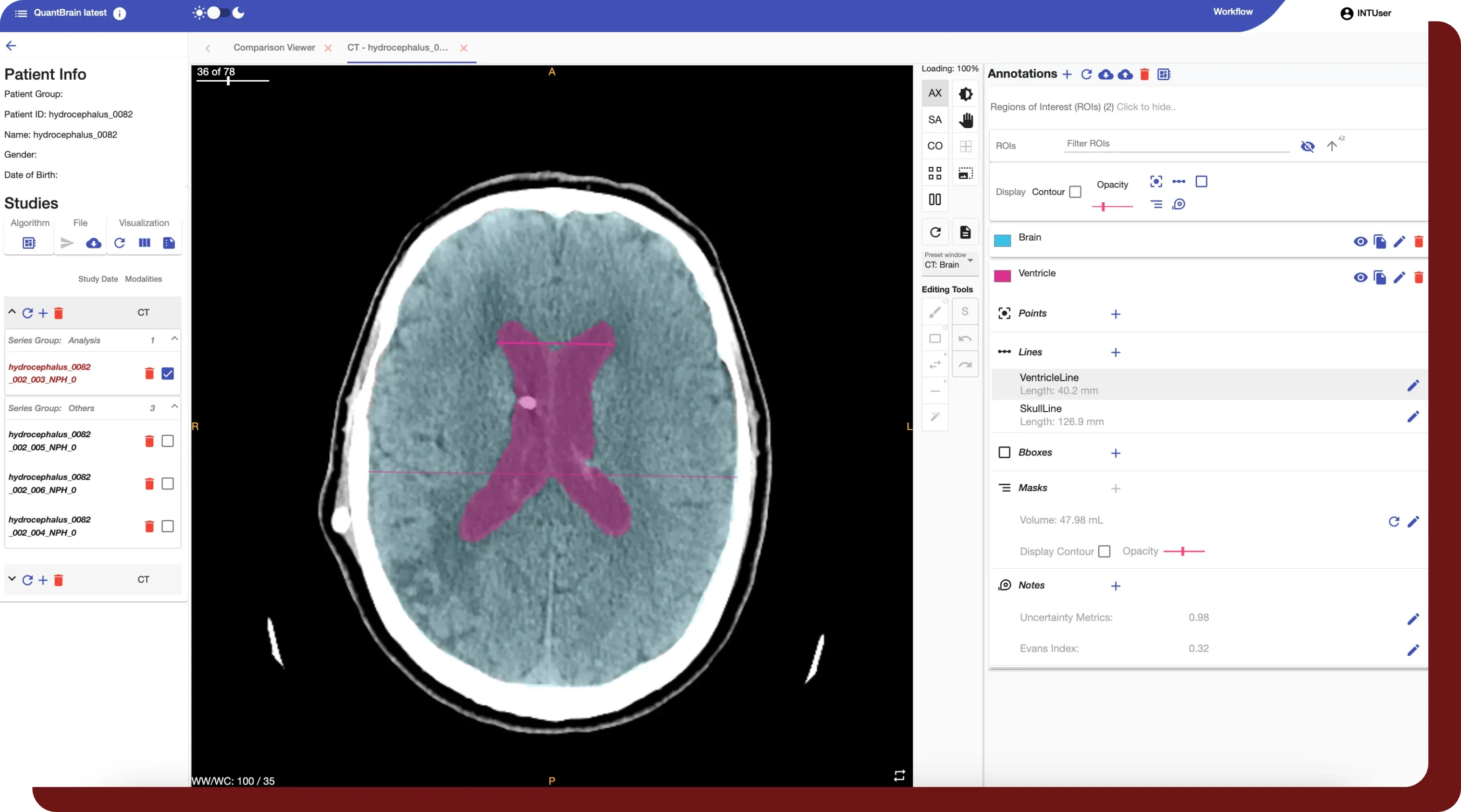 QuantBrain workstation showing automatic ventricle segmentation overlaid on an axial CT slice