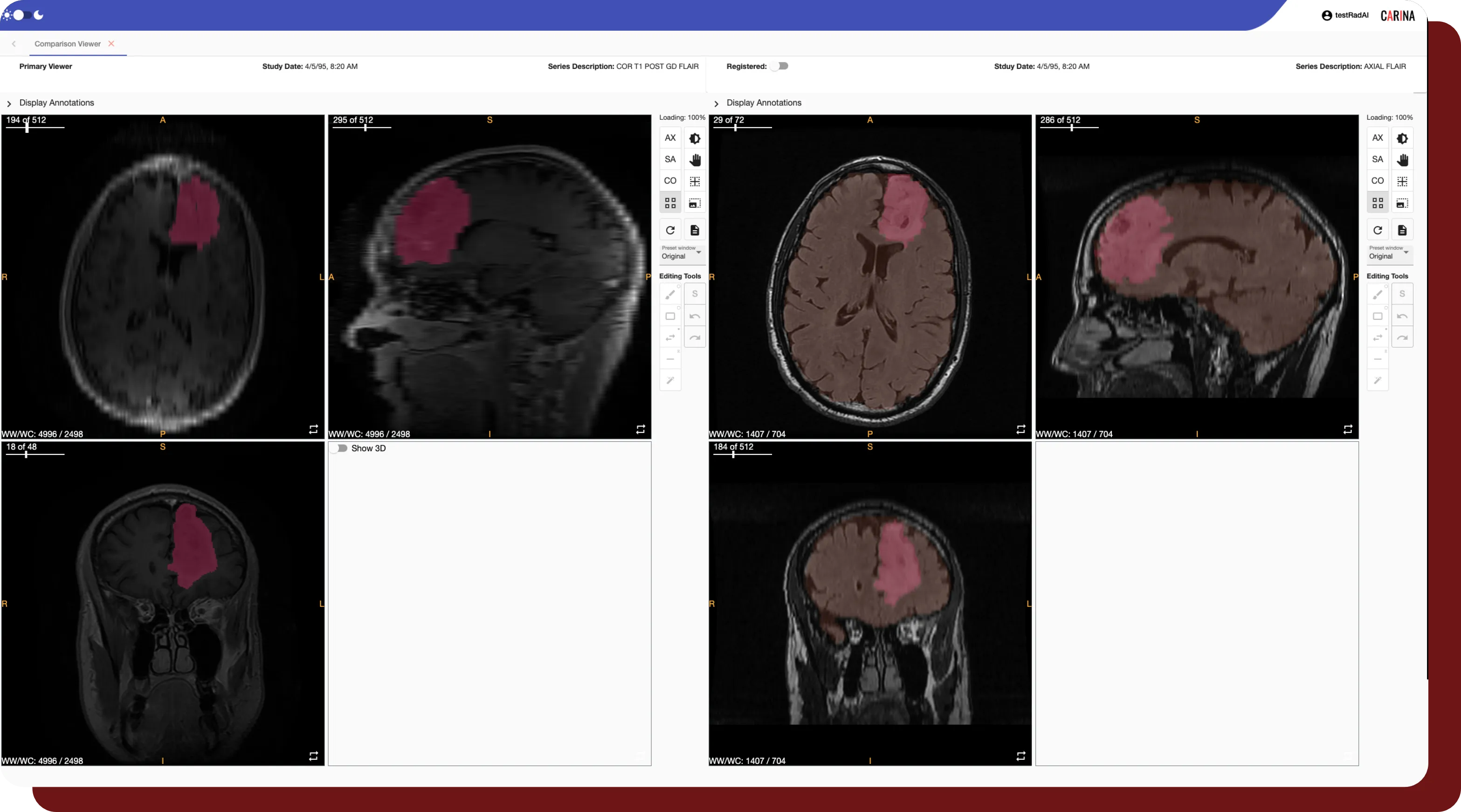 An example of OncoAI - BrainTumor's Comparison Viewer features between series.
