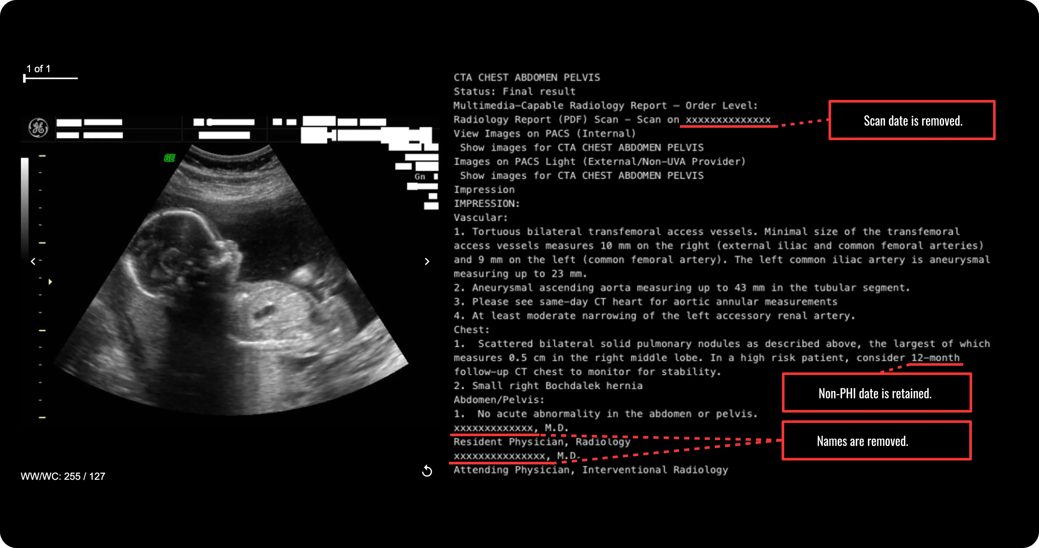 An example of the burned-in text removal and report de-identification features available in DeIdentifier.