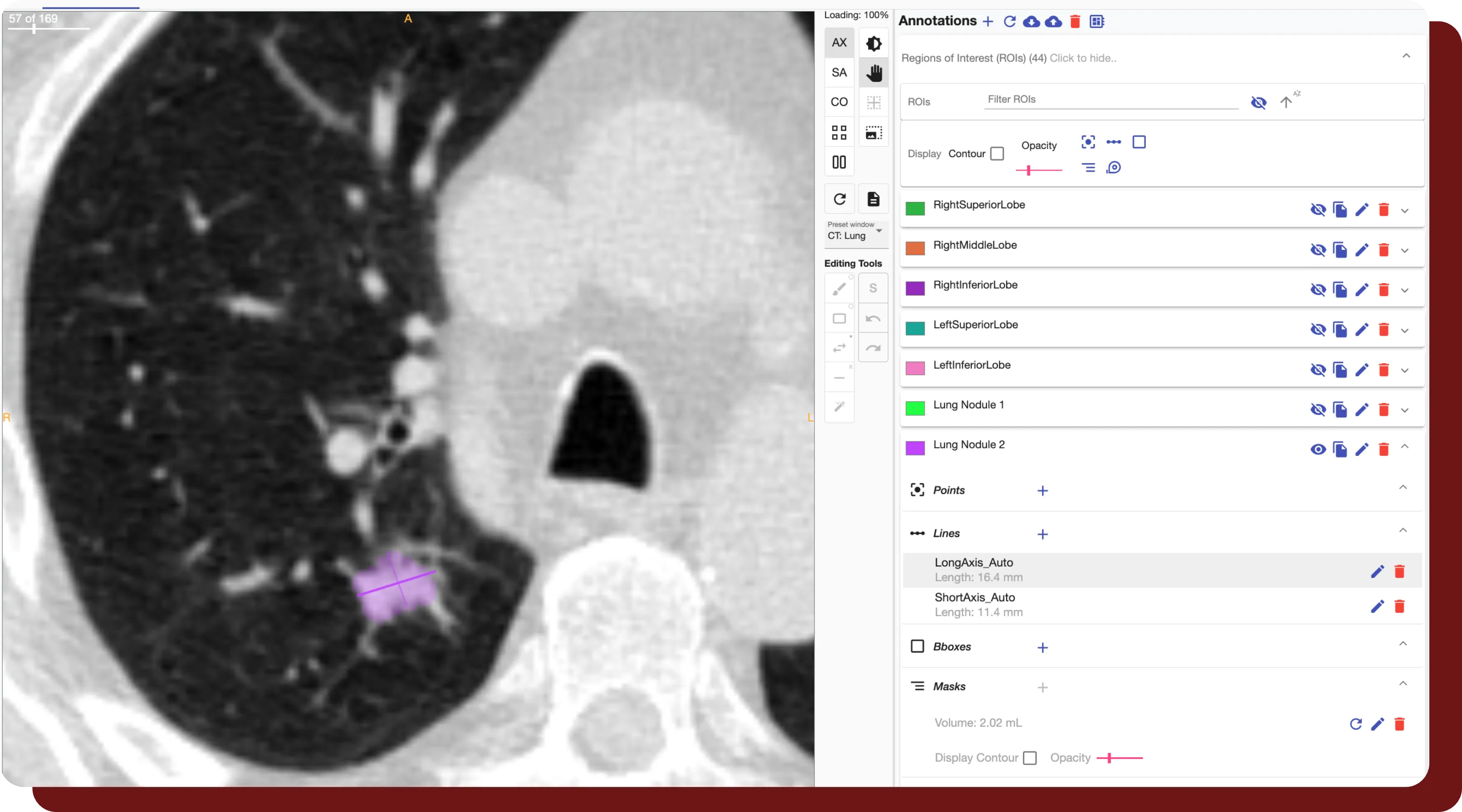 An figure showing a study that has been automatically segmented for lung nodules, being shown in OncoAI - LungNodule's built-in viewer.