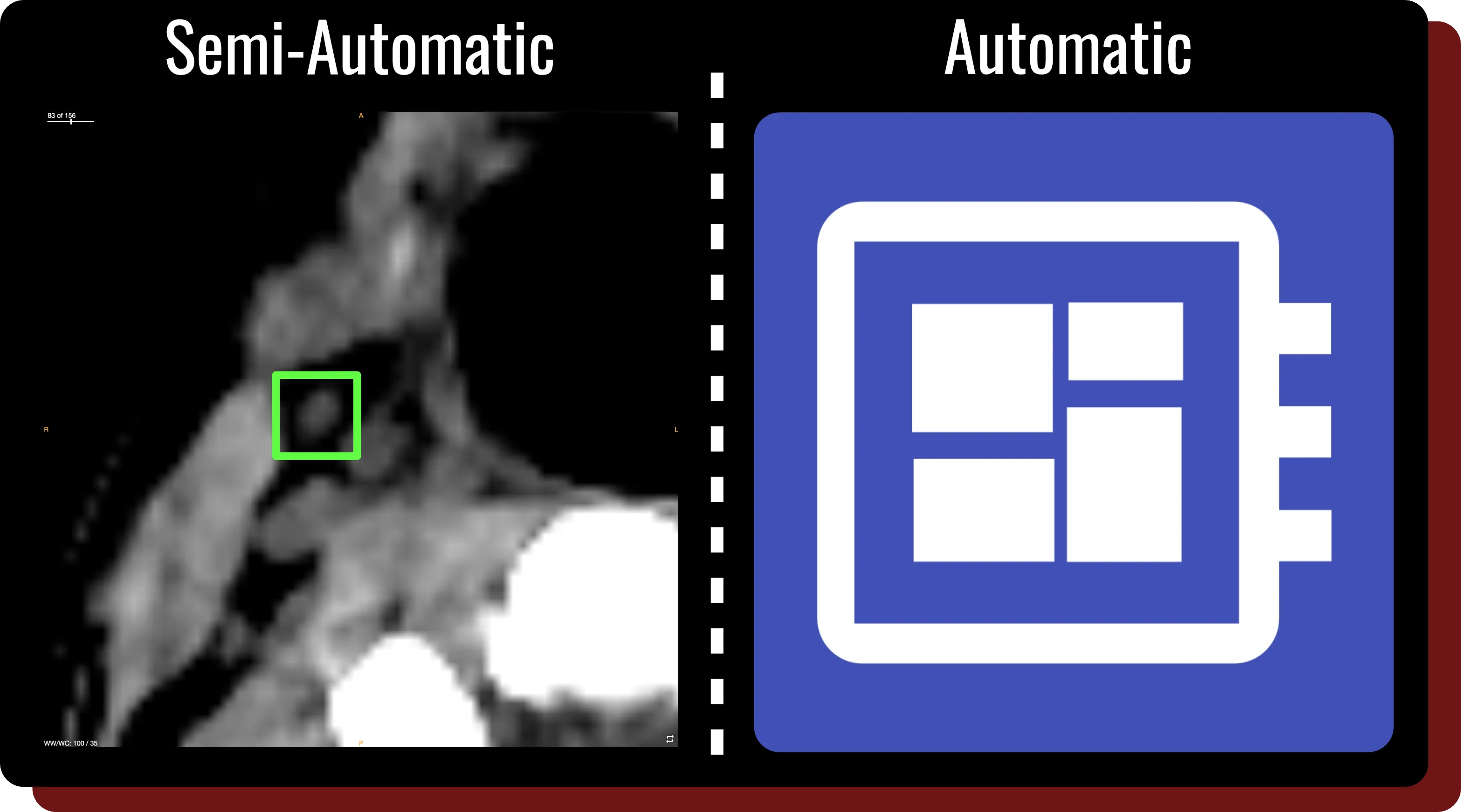 A figure representing both the semi-automatic and automatic segmentation functionality within OncoAI - LymphNode.