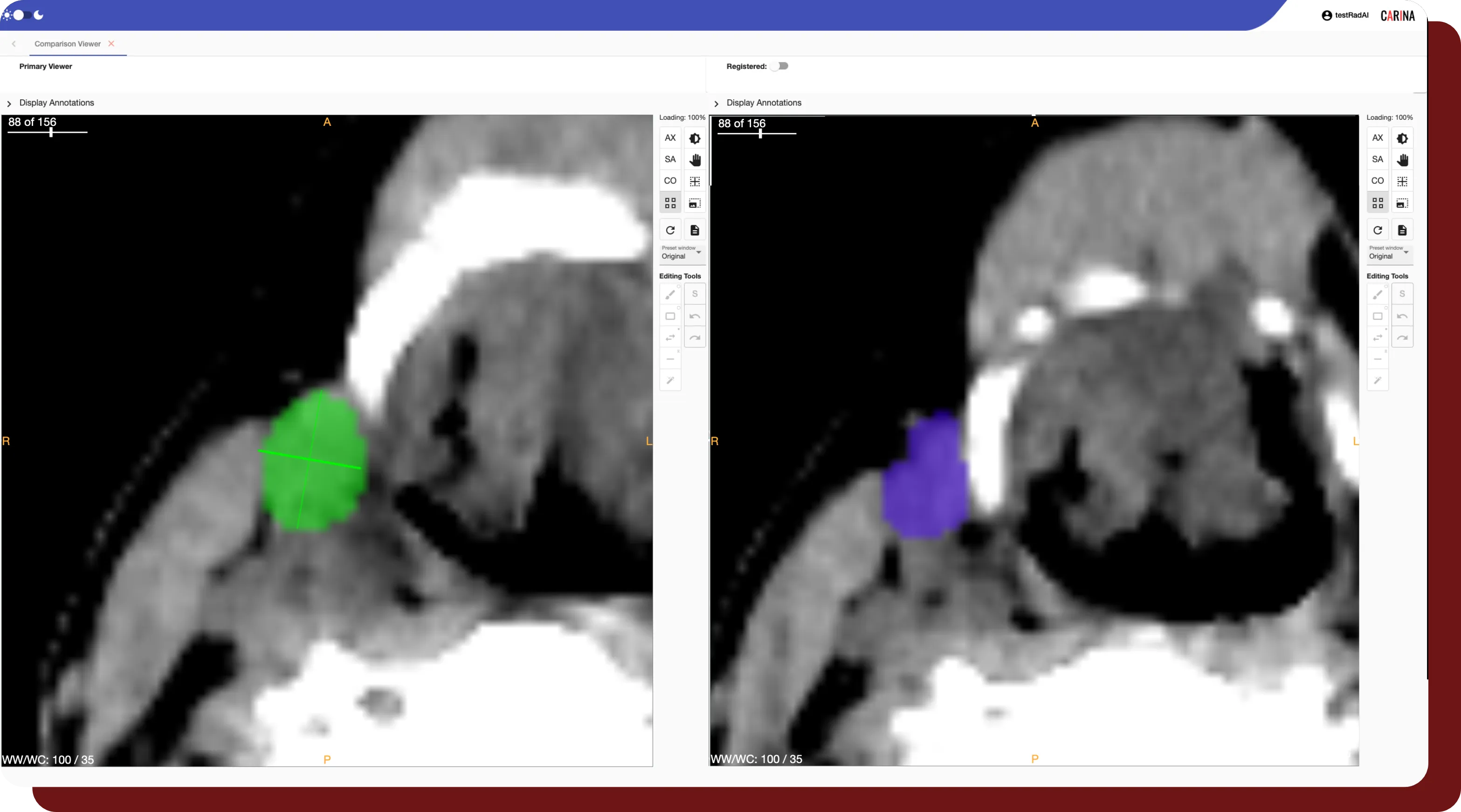 An example of the comparison viewer used in OncoAI - LymphNode.