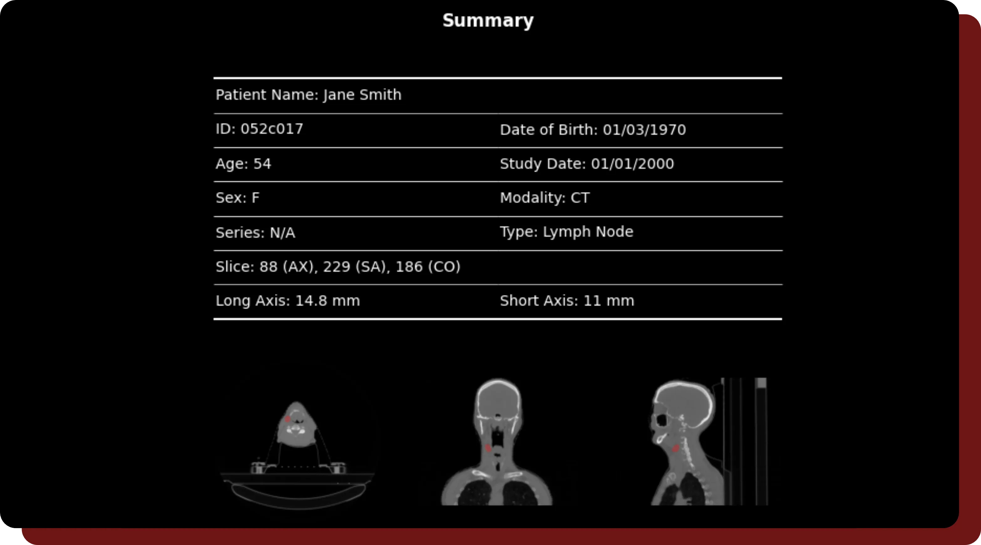 A sample report generated from a segmented study in QuantBrain - LymphNode.