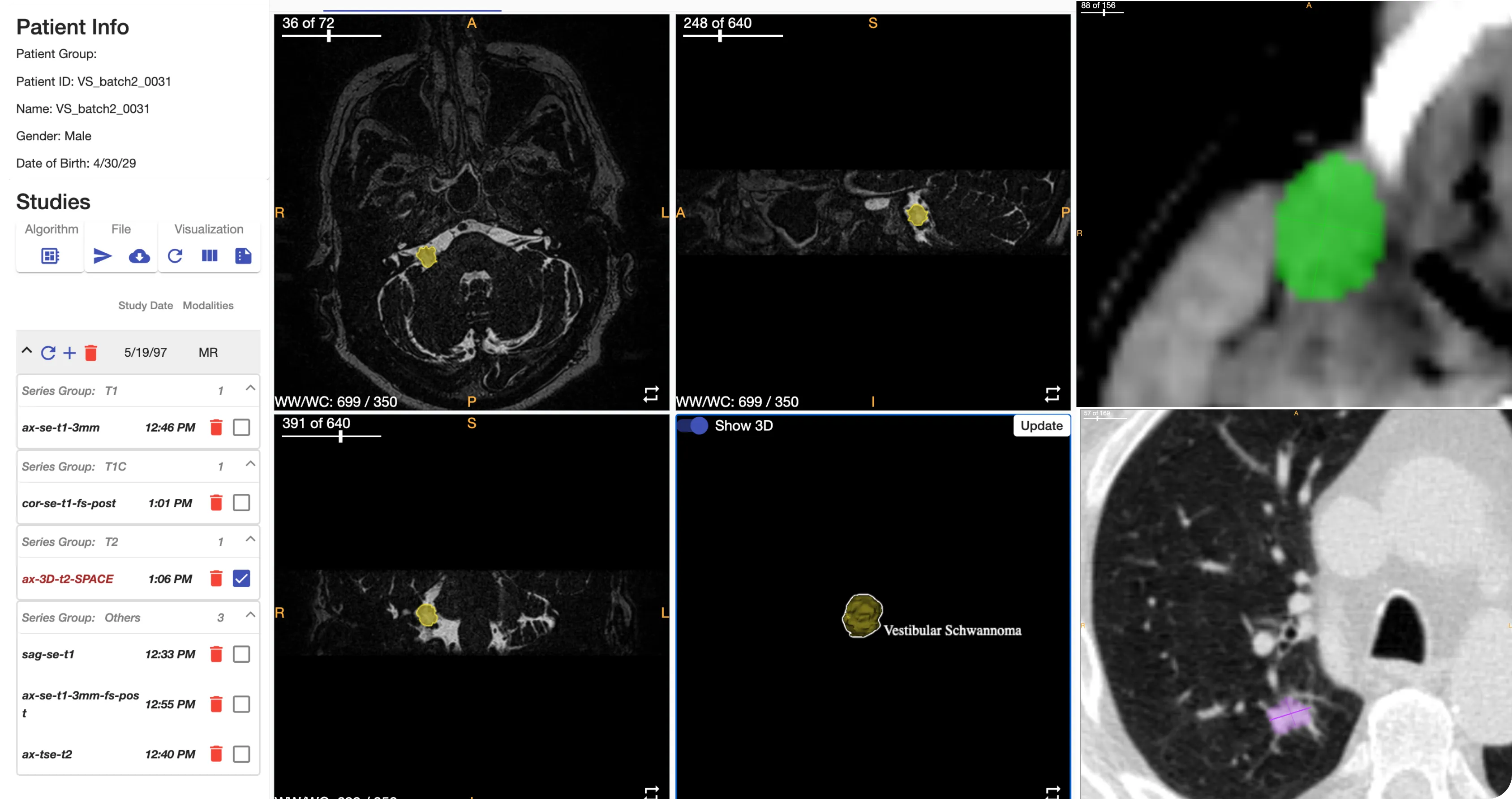 Multiple example studies highlighting the automated segmentation features within OncoAI Suite.