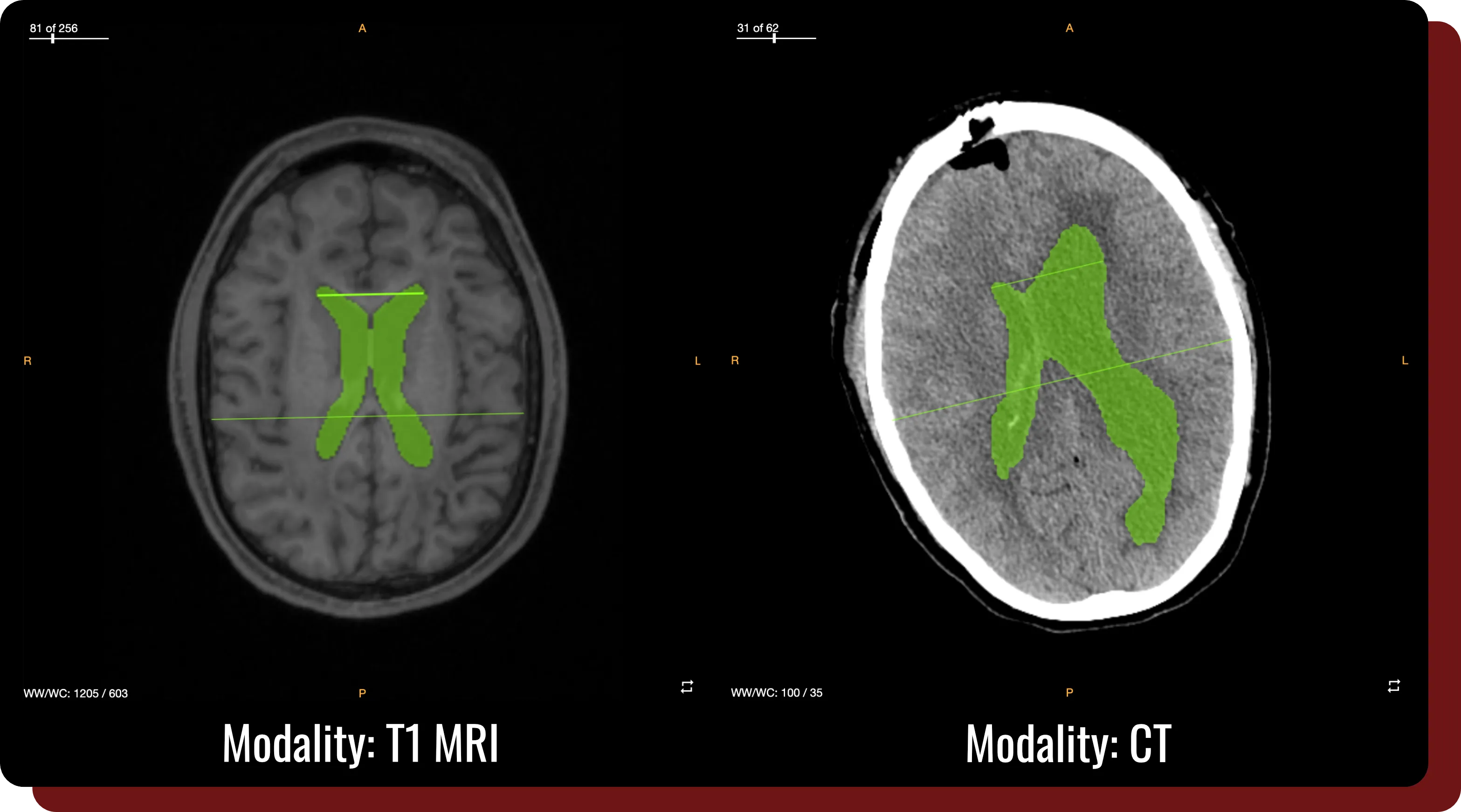 A figure illustrating the different compatible modalities within QuantBrain - Ventricle.