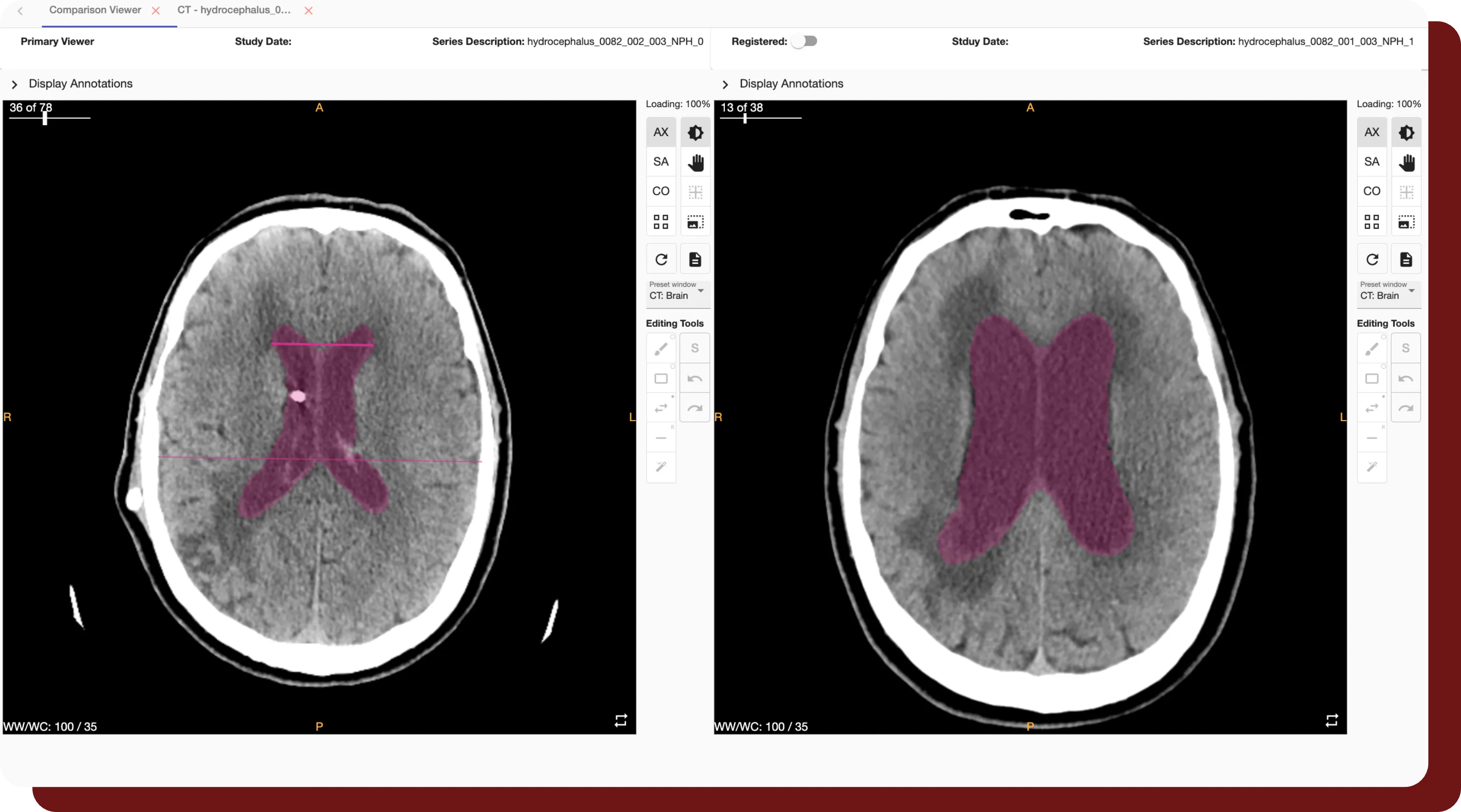 An example of the Comparison Viewer feature available in QuantBrain - Ventricle.