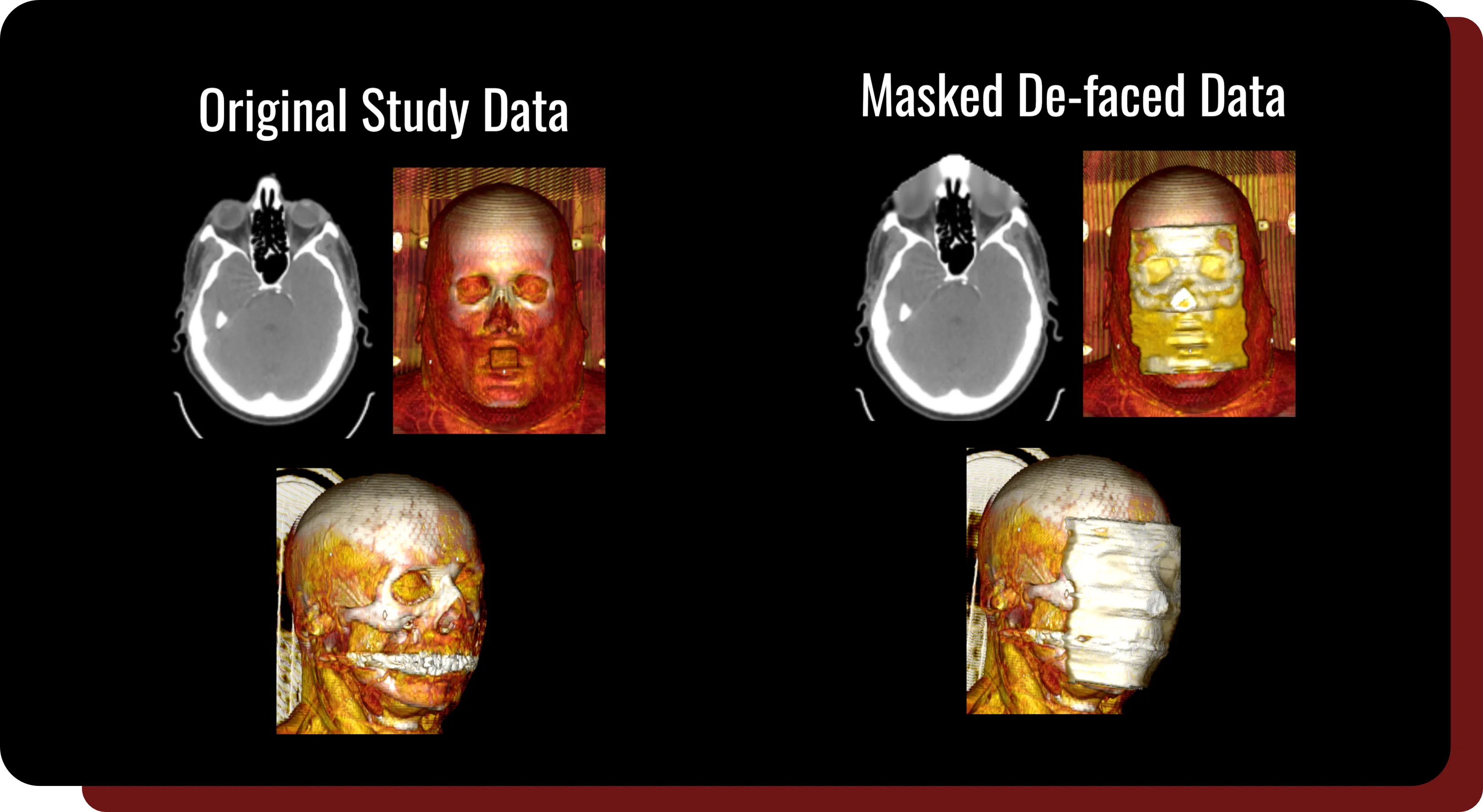Six different medical images of a face, with the first three being original medical data, and the final three being images that have been de-faced to remove any identifiable features.